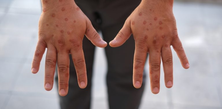 First Case of New Mpox Strain Detected in UK