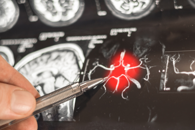 Researchers Identify Alzheimer’s “Death Switch”